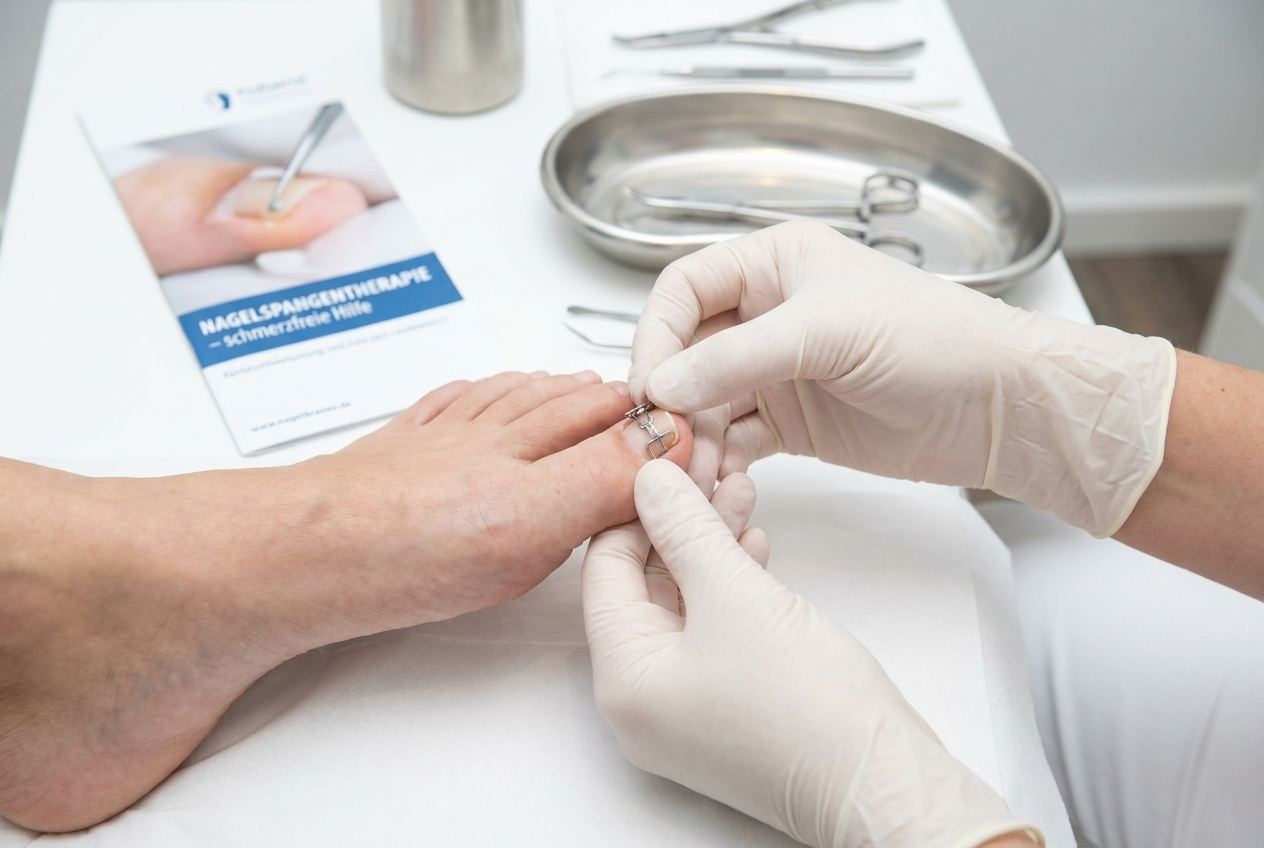 Nagelspangentherapie: Anbringen einer Nagelspange am Großzehennagel